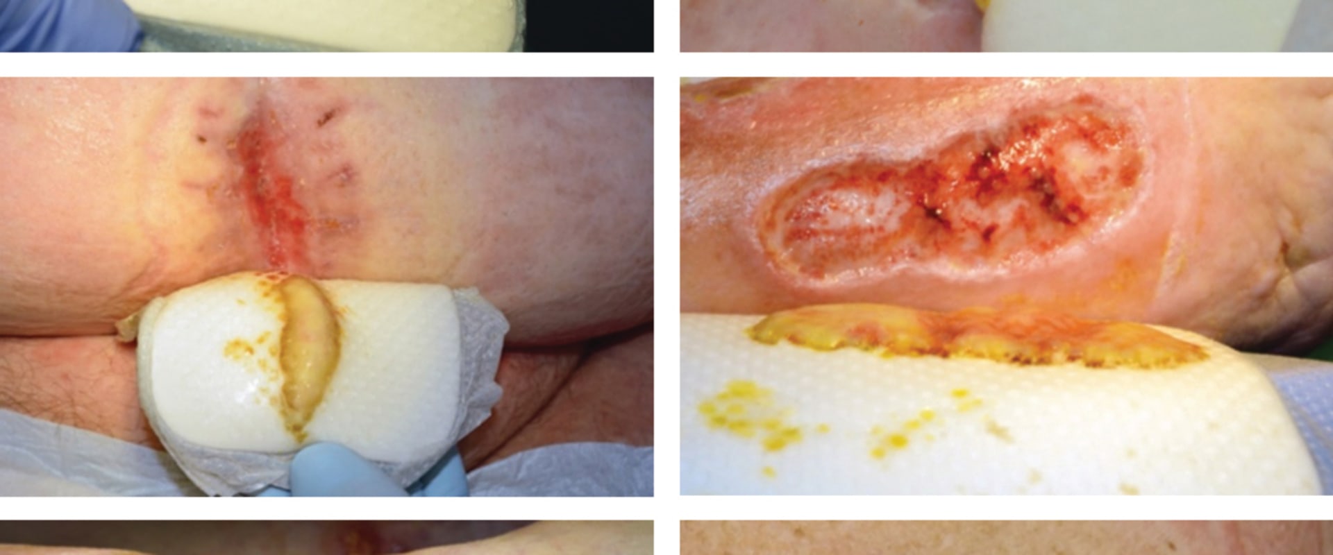 The Role of Wound Exudate in the Healing Process
