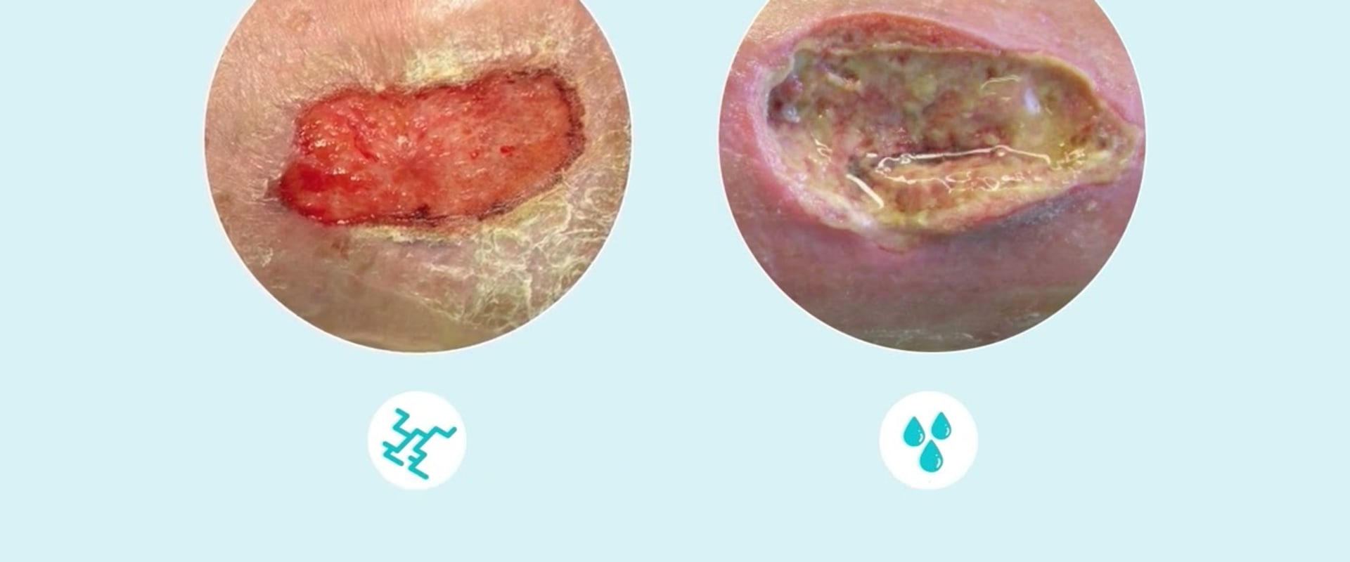 The Importance of Understanding Wound Exudate for Effective Treatment and Healing