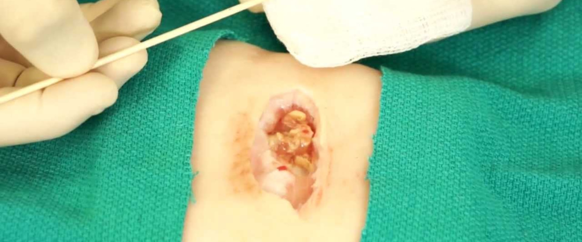 Silver Nitrate Sticks on Skin: Safe Tips You Need to Know