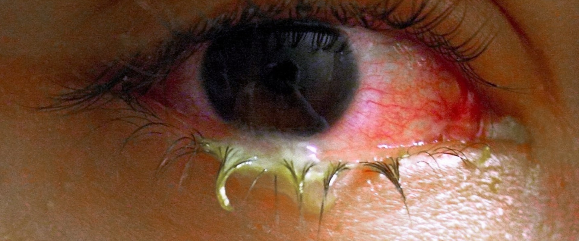 The Importance of Understanding Wound Exudate