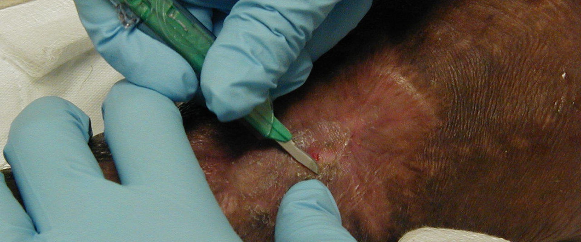 The Importance of Exudate in Wound Care