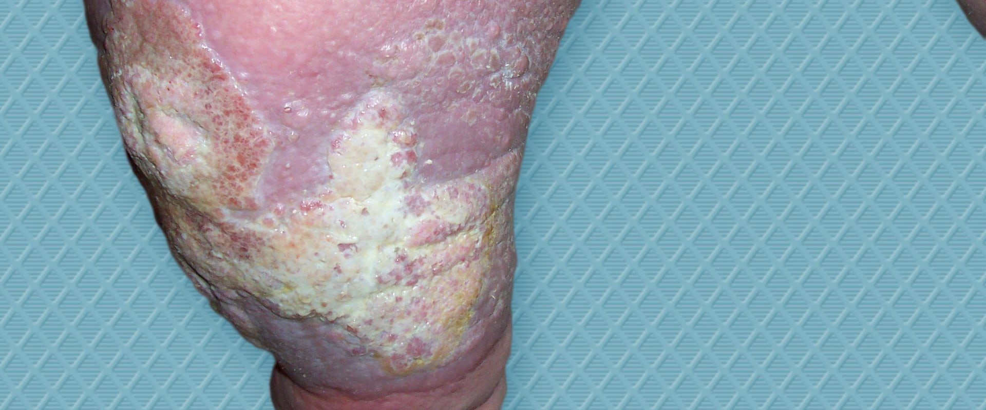 The Role of Exudate in Wound Healing