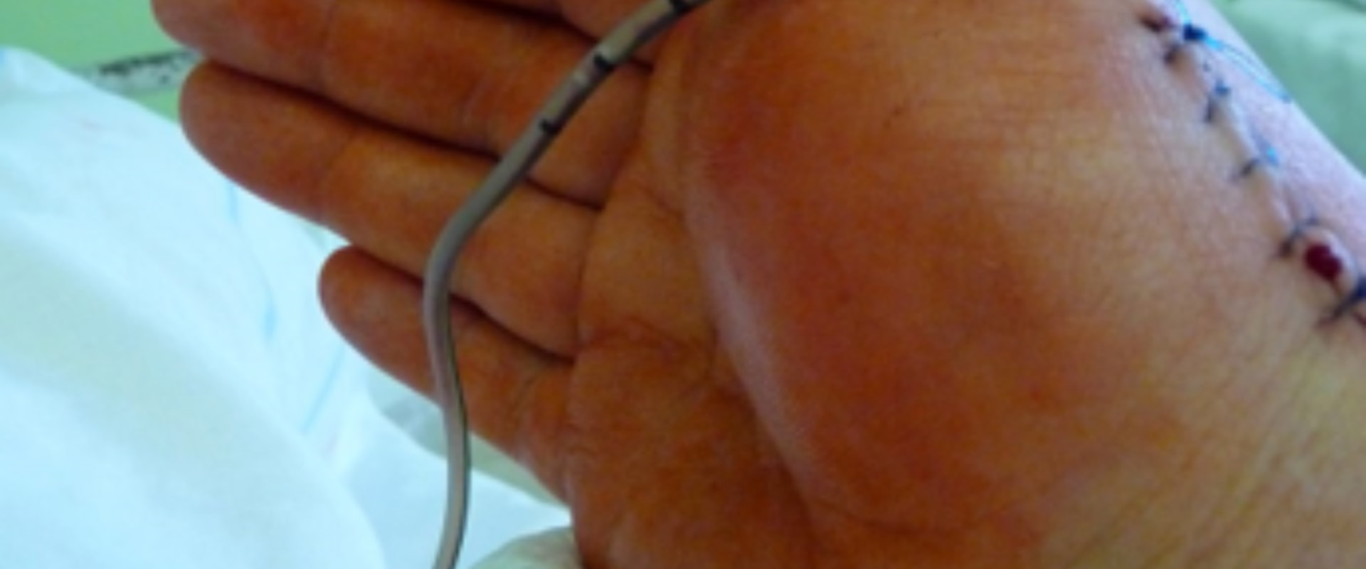 The Importance of Understanding Different Types of Wound Drainage