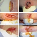 Understanding the Different Types of Wound Drainage: A Specialist's Perspective