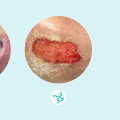 The Importance of Exudate Color in Wound Healing