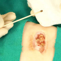 Silver Nitrate Sticks on Skin: Safe Tips You Need to Know