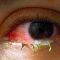 The Importance of Understanding Wound Exudate