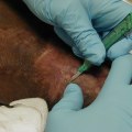 The Importance of Exudate in Wound Care
