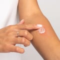 Treating Cuts and Sores? Find the Right Antibiotic for Wounds