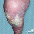 The Role of Exudate in Wound Healing