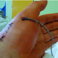 The Importance of Understanding Different Types of Wound Drainage