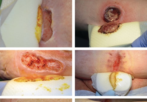 The Role of Exudate in Wound Healing: Types, Treatment, and Importance
