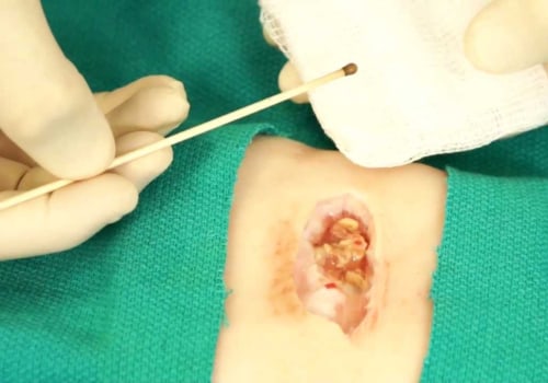 Silver Nitrate Sticks on Skin: Safe Tips You Need to Know