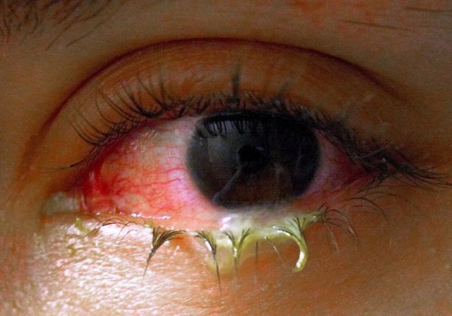 The Importance of Understanding Wound Exudate