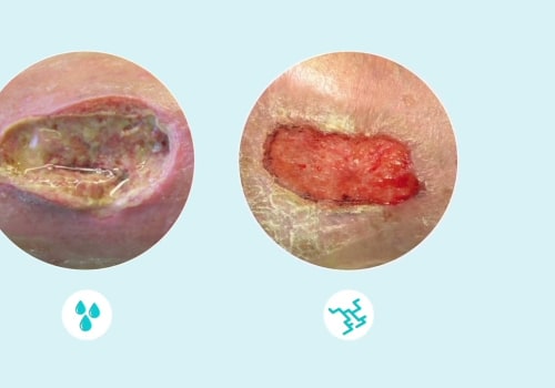 Understanding the Importance of Wound Exudate Management