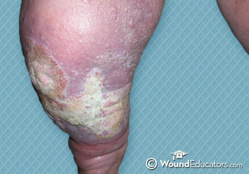 The Role of Exudate in Wound Healing