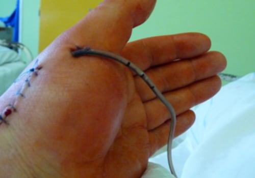 The Importance of Understanding Different Types of Wound Drainage